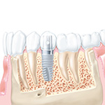 Implants dentaires Paris