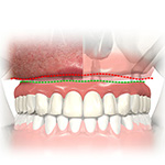 implants zygomatiques