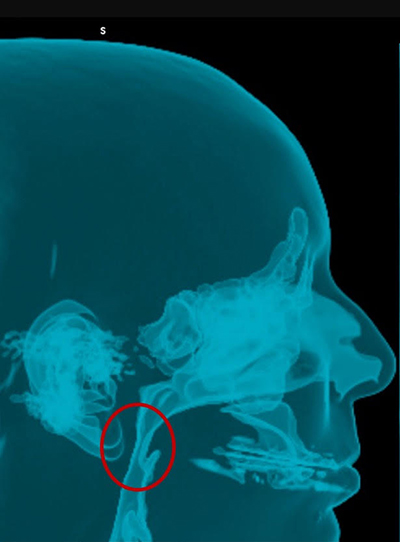 Chirurgie orthognatique - Indications fonctionnelles