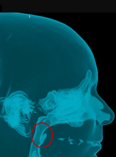 Chirurgie orthognatique - Indications fonctionnelles