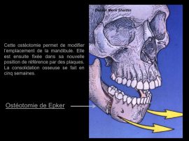 Ostéotomie de Epker
