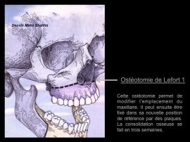 Ostéotomie de Lefort