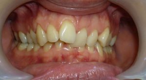 Les dents ont ici une mauvaise position parce que les structures osseuses qui les soutiennent ont elles-mêmes une mauvaise position. Les dents tant qu'elles ne sont pas stabilisées (occlusion stable) continuent à bouger.