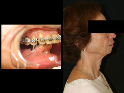 L'indication chirurgicale est posée de par l'importance du décalage dentaire et de par la disharmonie du visage. L'un et l'autre sont ici la conséquence d'un défaut de croissance de la mandibule qui sera corrigé chirurgicalement.