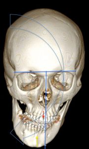 Exemple d'une asymétrie faciale nécessitant une prise en charge orthodontique et chirurgicale. L'axe médian est représenté en bleu. Le maxillaire est dévié à droite (flèche rouge). La mandibule est également déviée à droite (flèche jaune) mais de façon plus importante. Le visage est concave vers la droite. La chirurgie permet de rétablir l'harmonie du visage.