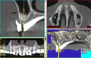 la position des implants est programmée en amont par informatique en fonction d'un guide radiologique qui simule la prothèse définitive