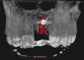 L'implant dentaire ( en rouge ) est positionné par informatique en fonction du guide qui simule la prothèse définitive