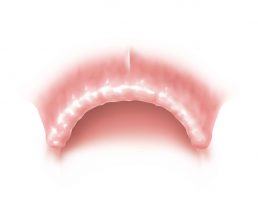 Maxillaire édenté total