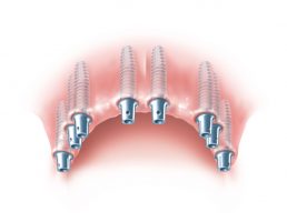 Huit implants dentaires sont posés