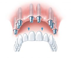 Le bridge est scellé sur les implants dentaires