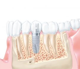 L’implant dentaire ne compromet pas la vitalité des dents adjacentes