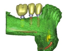 La pose des implants est simulée à l’avance par informatique