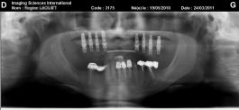 8 implants ont été placés après la reconstruction osseuse (patient des 2 photos précédentes).