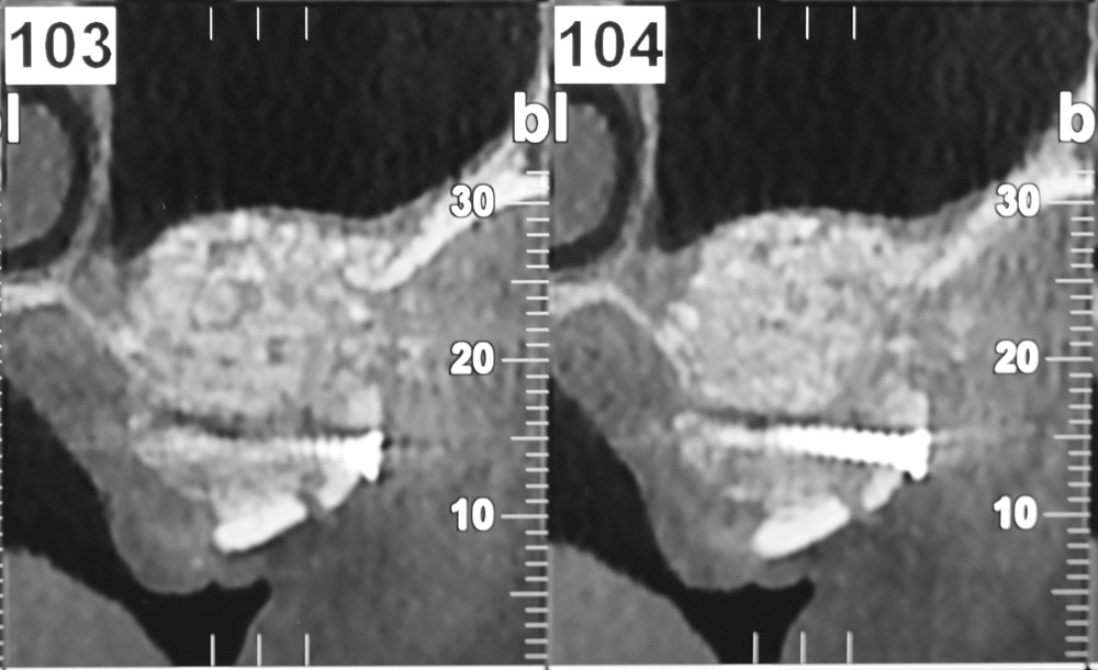 L'extraction dentaire – préservation osseuse avant la mise en place d'un  implant dentaire Le Perreux sur Marne (94170)