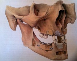 Reconstructions à partir d’un prélèvement de ramus visible en arrière sur la branche montante de la mandibule et d’un prélèvement de symphyse visible à l’avant, au niveau de la symphyse mandibulaire.