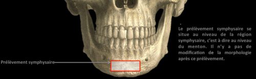 La symphyse est une zone anatomique osseuse située entre les canines. Un prélèvement osseux est possible à ce niveau.