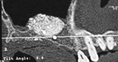 Résultat d’un comblement de sinus réalisé sous anesthésie locale. Un substitut osseux a été placé. Il est visible en blanc. Le gain osseux permet la mise en place d’implants.