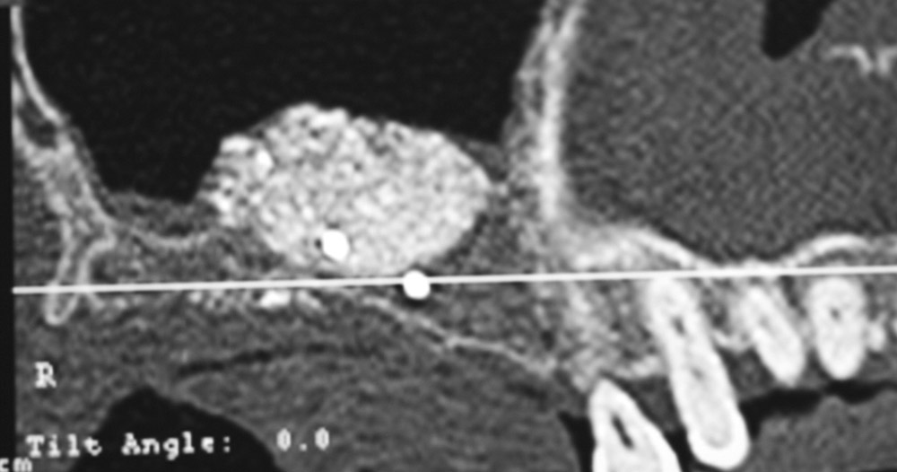 L'extraction dentaire – préservation osseuse avant la mise en place d'un  implant dentaire Le Perreux sur Marne (94170)