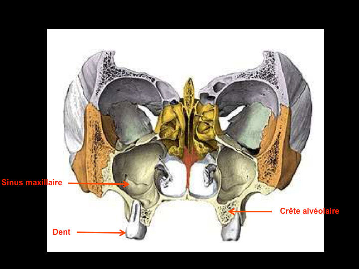 L'extraction dentaire – préservation osseuse avant la mise en place d'un  implant dentaire Le Perreux sur Marne (94170)