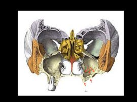 Avec la perte des dents le sinus maxillaire augmente de volume et vient recouvrir la crête osseuse qui disparaît.