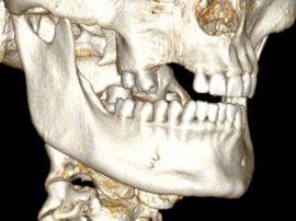 La perte des dents au niveau du maxillaire à droite est responsable d'une perte osseuse transversale. La crête osseuse est fine.