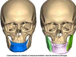 simulation intervention
