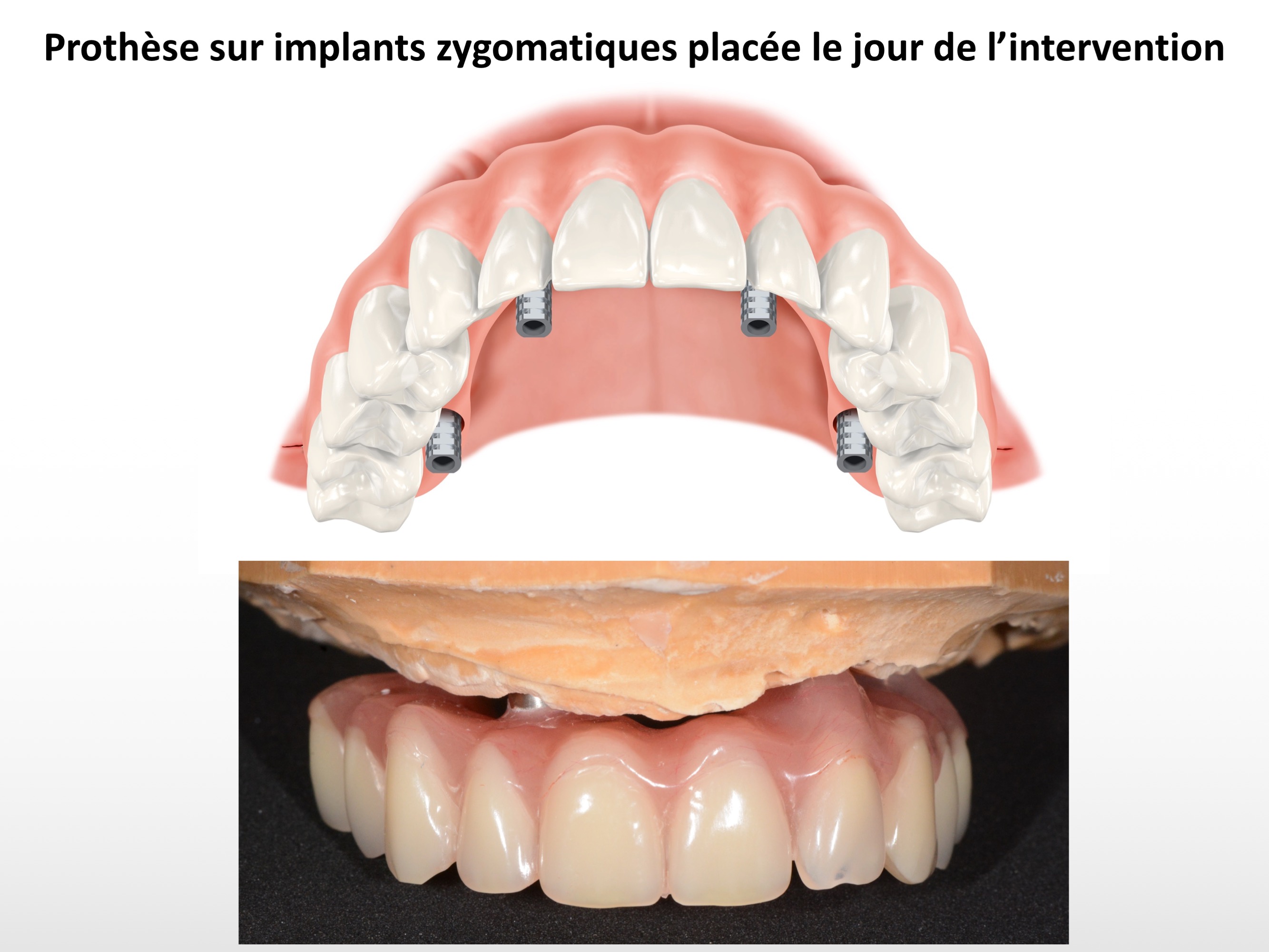 Prothèse immédiate provisoire