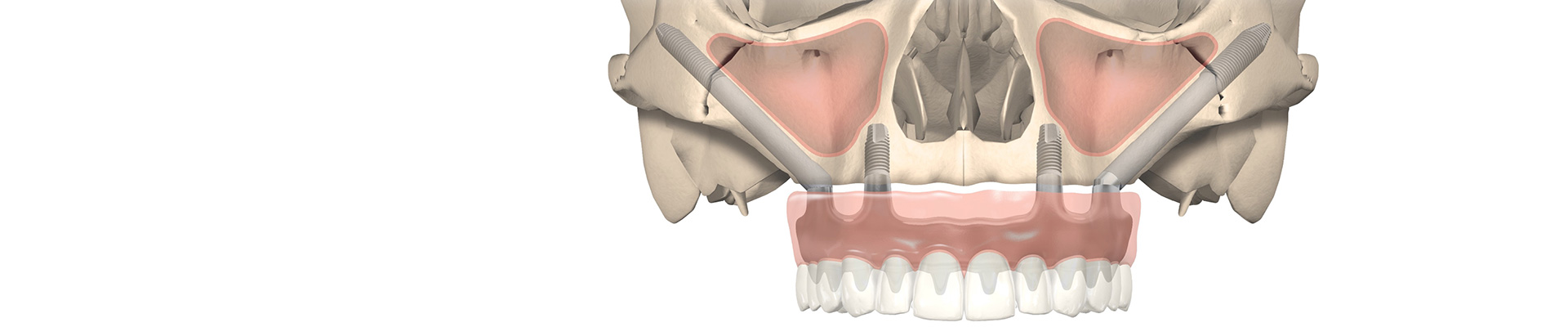 Implants zygomatiques