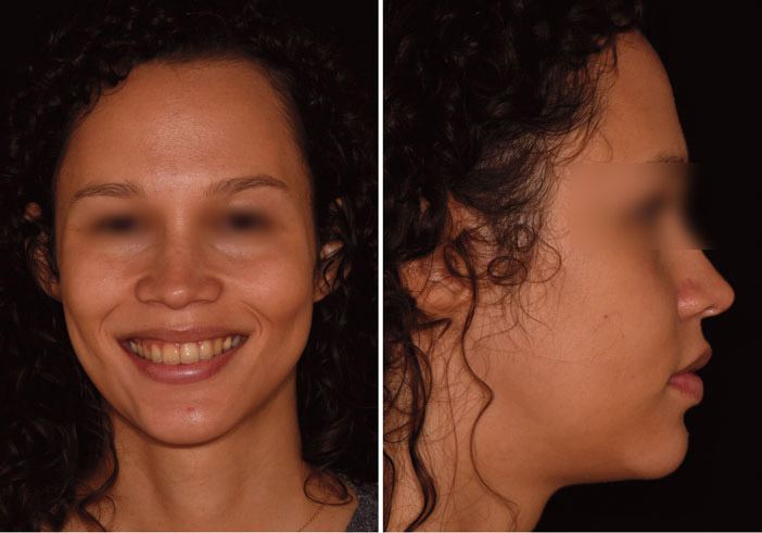 Fig. 15 : l’harmonie du sourire est conforme aux attentes de la patiente Fig. 16 : de profil le visage est harmonieux