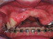 Dr Solyom - prise en charge sourire gingival