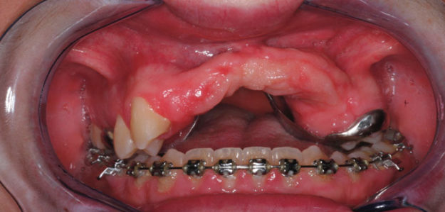 Dr Solyom - prise en charge sourire gingival