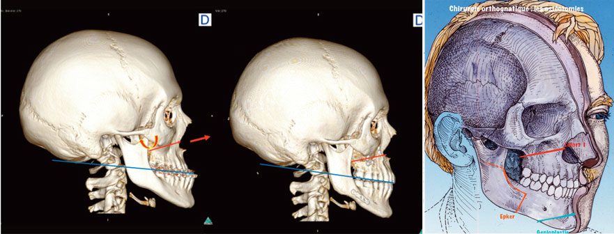 chirurgie orthognatique