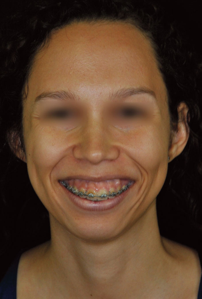 sourire gingival