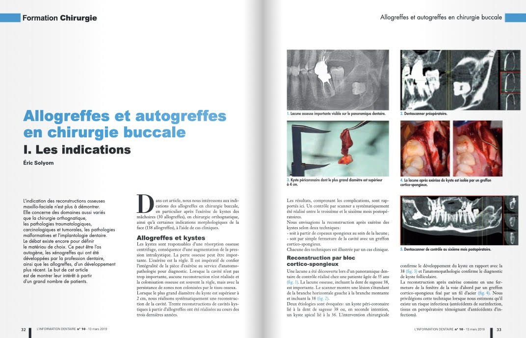 Allogreffes et autogreffes en chirurgie buccale