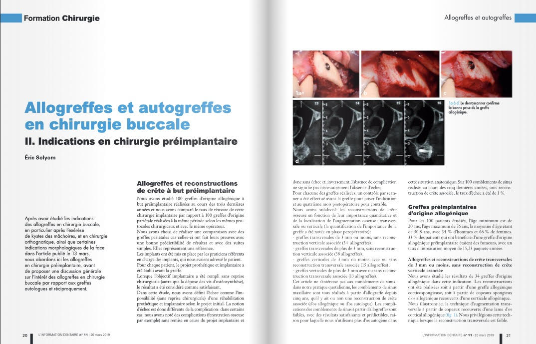 Allogreffes et autogreffes en chirurgie buccale