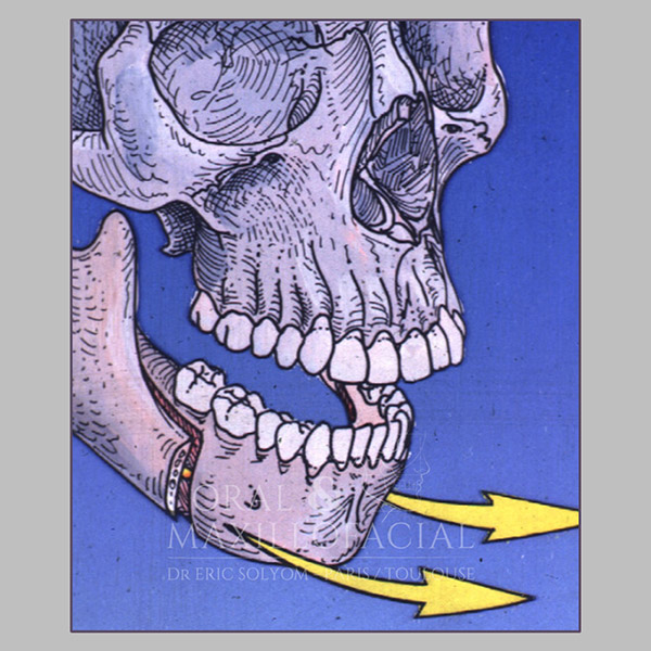 La chirurgie orthognatique - Implants dentaires Paris et Toulouse ...